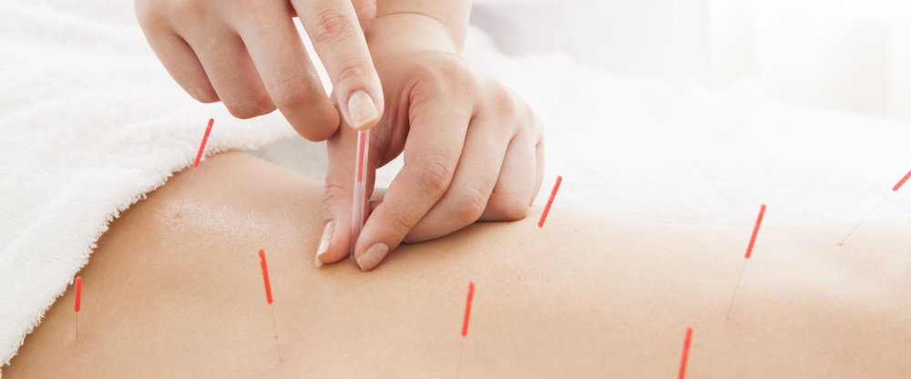 はり治療を受ける腰